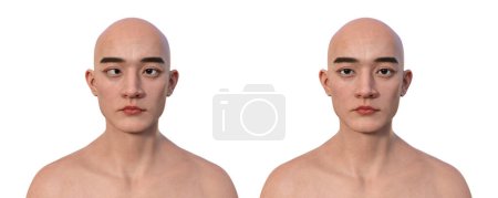 Foto de Un hombre con esotropía y la misma persona sana. Ilustración 3D que muestra la desalineación del ojo interno. - Imagen libre de derechos