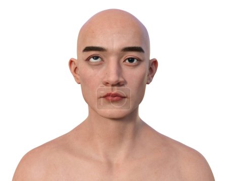 Foto de Un hombre con hipertropía, ilustración en 3D con desalineación del ojo hacia arriba. - Imagen libre de derechos