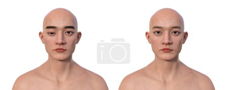 Foto de Un hombre con hipotropía y el mismo hombre sano, ilustración 3D mostrando desalineación de los ojos hacia abajo. - Imagen libre de derechos
