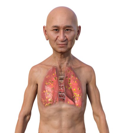 Foto de Un hombre con piel transparente que revela histoplasmosis pulmonar, una infección fúngica causada por Histoplasma capsulatum. Ilustración 3D que muestra pequeños nódulos dispersos por los pulmones. - Imagen libre de derechos