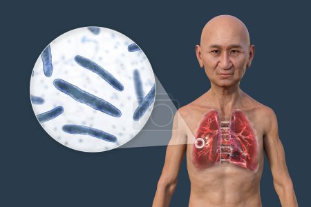 Foto de Una ilustración fotorrealista 3D de un hombre con piel transparente, mostrando los pulmones afectados por la tuberculosis cavernosa, y una vista cercana de las bacterias Mycobacterium tuberculosis. - Imagen libre de derechos