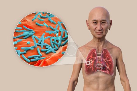Foto de Una ilustración fotorrealista 3D de un hombre con piel transparente, mostrando los pulmones afectados por la tuberculosis cavernosa, y una vista cercana de las bacterias Mycobacterium tuberculosis. - Imagen libre de derechos