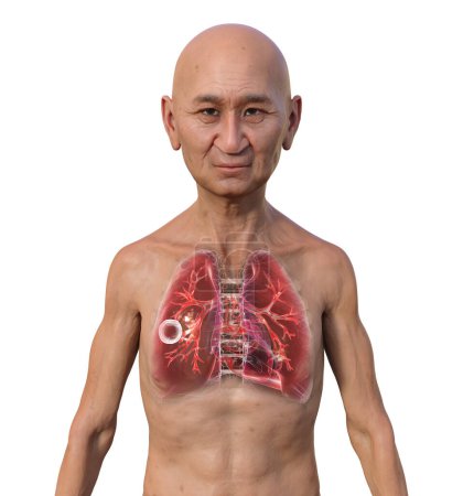 Foto de Una ilustración fotorrealista en 3D de un hombre con piel transparente, mostrando los pulmones afectados por la tuberculosis cavernosa. - Imagen libre de derechos
