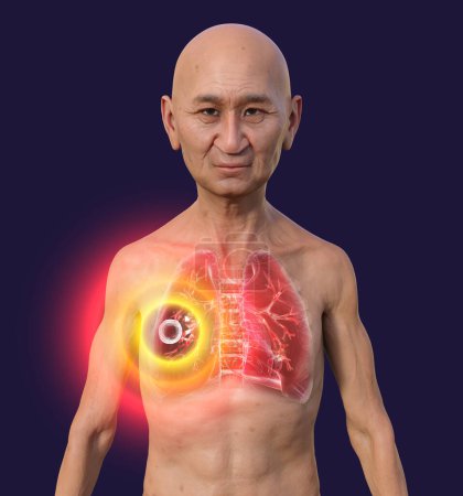 Foto de Una ilustración fotorrealista en 3D de un hombre con piel transparente, mostrando los pulmones afectados por la tuberculosis cavernosa. - Imagen libre de derechos