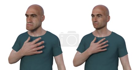 Acromégalie chez un homme, et le même homme en bonne santé. Illustration 3D montrant une augmentation de la taille des mains et du visage due à une surproduction de somatotrophine causée par une tumeur de l'hypophyse.