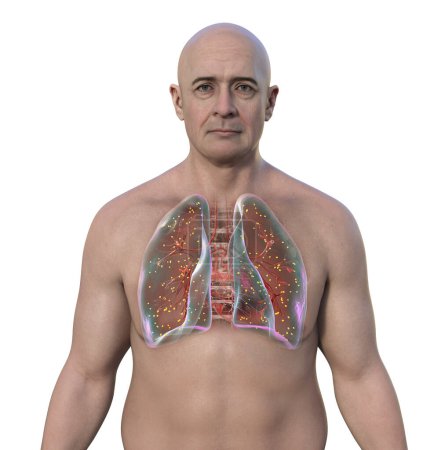 Foto de Un hombre con adiaspiromicosis pulmonar, una infección respiratoria causada por el hongo Emmonsia spp., caracterizada por la presencia de esporas fúngicas encapsuladas agrandadas dentro de los tejidos pulmonares, ilustración 3D. - Imagen libre de derechos