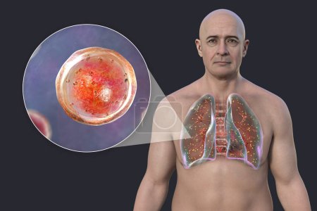 Foto de Un hombre con adiaspiromicosis pulmonar, una infección respiratoria causada por el hongo Emmonsia spp., caracterizada por la presencia de esporas fúngicas encapsuladas agrandadas dentro de los tejidos pulmonares, ilustración 3D. - Imagen libre de derechos