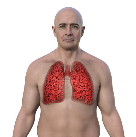 Foto de Un hombre con la piel transparente que revela los pulmones del fumador, ilustración 3D. - Imagen libre de derechos