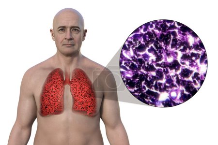 Photo for A man with smoker's lungs, 3D illustration along with a photomicrograph image of lungs affected by smoking. - Royalty Free Image