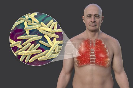 Foto de Una ilustración en 3D que muestra la mitad superior de un hombre con la piel transparente, revelando los pulmones afectados por la tuberculosis miliar, y la vista de cerca de la bacteria Mycobacterium tuberculosis. - Imagen libre de derechos