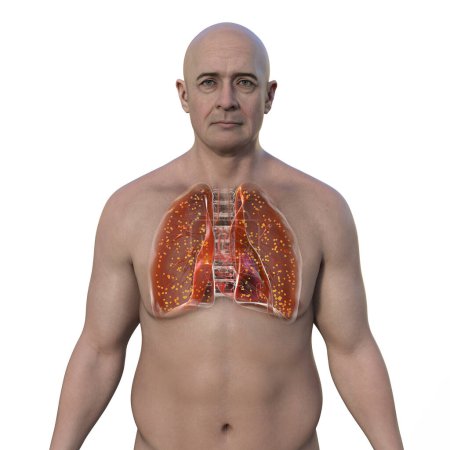 Téléchargez les photos : Illustration 3D montrant la moitié supérieure d'un homme à la peau transparente, révélant les poumons atteints de tuberculose miliaire. - en image libre de droit