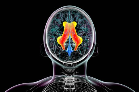 Téléchargez les photos : Illustration scientifique 3D représentant des ventricules latéraux élargis du cerveau (hydrocéphalie), vue du dessus. - en image libre de droit