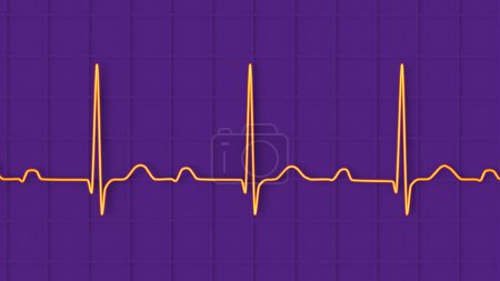 Téléchargez les photos : Illustration 3D d'un ECG affichant un bloc AV au 1er degré, un trouble de conduction cardiaque - en image libre de droit