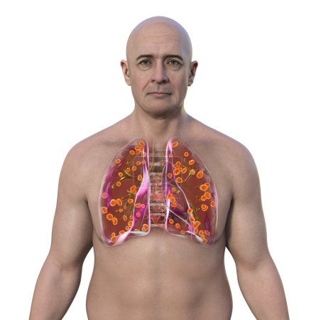 Photo for A man with transparent skin revealing lung histoplasmosis, a fungal infection caused by Histoplasma capsulatum. 3D illustration showing small nodules scattered throughout the lungs. - Royalty Free Image