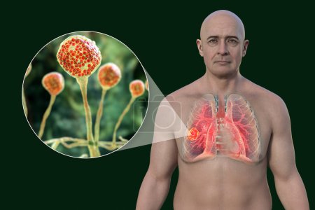 Foto de Un hombre con lesión de mucormicosis pulmonar, y vista de cerca de los hongos Mucor, uno de los agentes etiológicos de la mucormicosis pulmonar, ilustración 3D. - Imagen libre de derechos