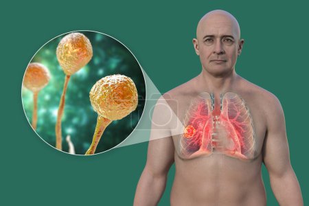 Téléchargez les photos : Un homme avec une lésion de mucormycose pulmonaire, et une vue rapprochée des champignons Mucor, l'un des agents étiologiques de la mucormycose pulmonaire, illustration 3D. - en image libre de droit