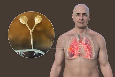 Foto de Un hombre con lesión de mucormicosis pulmonar, y vista de cerca de hongos Rhizomucor, uno de los agentes etiológicos de la mucormicosis pulmonar, ilustración 3D. - Imagen libre de derechos