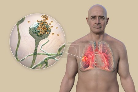 Téléchargez les photos : Un homme avec une lésion de la mucormycose pulmonaire, et une vue rapprochée des champignons Rhizopus, l'un des agents étiologiques de la mucormycose pulmonaire, illustration 3D. - en image libre de droit