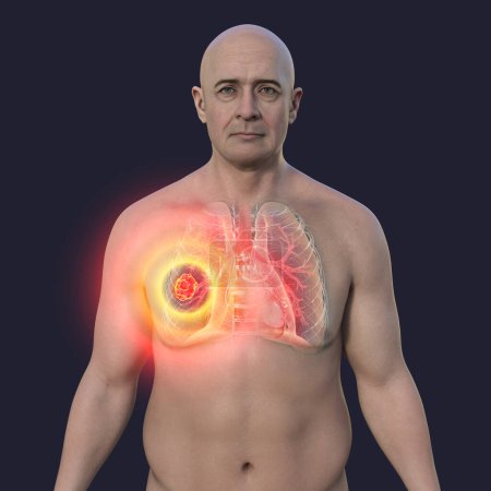 Téléchargez les photos : Un homme à la peau transparente, révélant une lésion de mucormycose pulmonaire, illustration 3D. - en image libre de droit