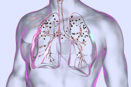 Téléchargez les photos : Illustration 3D médicale représentant les poumons affectés par la silicose dans un corps humain transparent, révélant des nodules silicotiques sombres, mettant l'accent sur les problèmes de santé respiratoire dus à l'exposition à la silice. - en image libre de droit