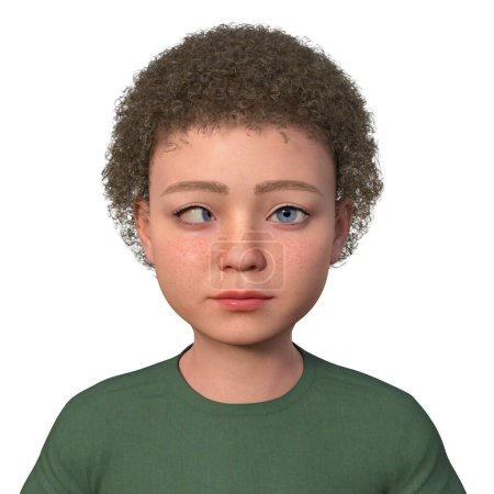 Foto de Un niño con esotropía, ilustración 3D que muestra una desalineación ocular interna. - Imagen libre de derechos