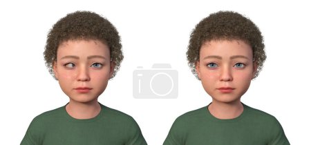Foto de Un niño con esotropía y la misma persona sana. Ilustración 3D que muestra la desalineación del ojo interno. - Imagen libre de derechos