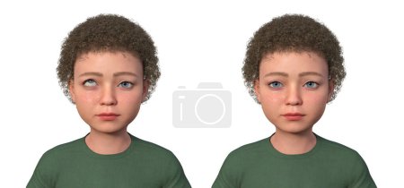 Foto de Un niño con hipertropía y el mismo hombre sano, ilustración 3D con desalineación del ojo hacia arriba. - Imagen libre de derechos