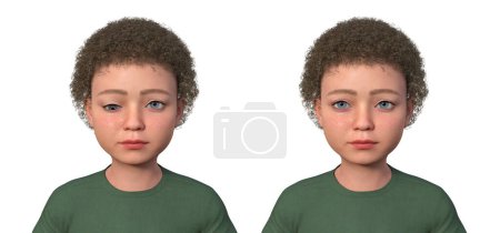 Foto de Un niño con hipotropía y el mismo hombre sano, ilustración 3D mostrando desalineación de los ojos hacia abajo. - Imagen libre de derechos