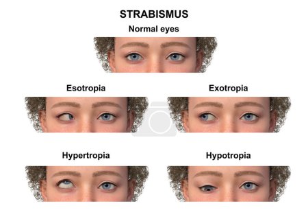 Photo for Annotated 3D illustration of a child with various strabismus types: esotropia, exotropia, hypertropia, and hypotropia. - Royalty Free Image