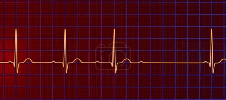Foto de Ilustración 3D visualizando un ECG con bloqueo AV de segundo grado (Wenckebach), destacando una conducción eléctrica anormal en el ritmo cardíaco. - Imagen libre de derechos