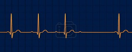 Foto de Ilustración 3D visualizando un ECG con bloqueo AV de segundo grado (Wenckebach), destacando una conducción eléctrica anormal en el ritmo cardíaco. - Imagen libre de derechos