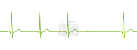 Illustration 3D visualisant un ECG avec bloc AV au 2ème degré (Wenckebach), mettant en évidence une conduction électrique anormale dans le rythme cardiaque.