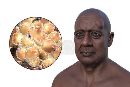 Foto de Lipoma en la frente de un hombre, y vista de cerca de los adipocitos, las células grasas que constituyen el crecimiento del lipoma, ilustración 3D. - Imagen libre de derechos