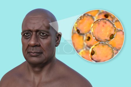 Foto de Lipoma en la frente de un hombre, y vista de cerca de los adipocitos, las células grasas que constituyen el crecimiento del lipoma, ilustración 3D. - Imagen libre de derechos