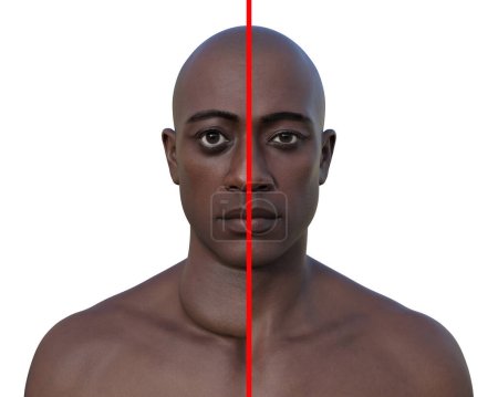 Foto de Un hombre con agrandamiento de la glándula tiroides y exoftalmos, y la misma persona sana, ilustración fotorrealista 3D. Concepto de tratamiento antes y después. - Imagen libre de derechos