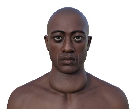 Foto de Un hombre con agrandamiento de la glándula tiroides y exoftalmos, ilustración fotorrealista 3D. - Imagen libre de derechos