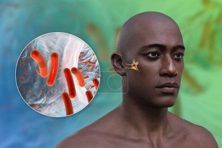 Foto de Otitis media infección del oído en un hombre, y vista de cerca de las bacterias, los agentes etiológicos de la inflamación del oído medio, ilustración 3D. - Imagen libre de derechos