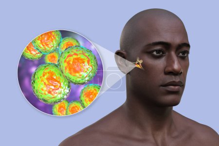 Foto de Otitis media infección del oído en un hombre, y vista de cerca de bacterias Moraxella catarrhalis, los agentes etiológicos comunes de la inflamación del oído medio, ilustración 3D. - Imagen libre de derechos