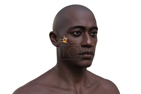 Foto de Otitis media en un hombre, una inflamación del oído medio, a menudo debido a una infección, que causa dolor de oído y problemas auditivos potenciales, ilustración 3D. - Imagen libre de derechos