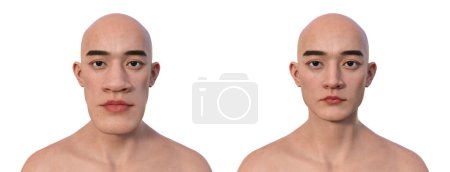 Photo for Acromegaly in a man, and the same healthy man. 3D illustration showing an increase in the size of the hands and face due to overproduction of somatotrophin caused by a tumour of the pituitary gland. - Royalty Free Image
