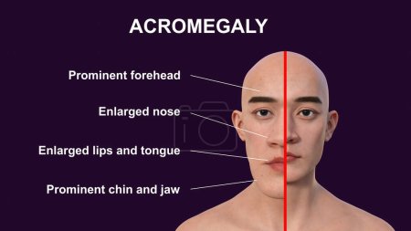Téléchargez les photos : Acromégalie chez l'homme, illustration 3D montrant une augmentation de la taille des mains et du visage due à une surproduction de somatotrophine causée par une tumeur de l'hypophyse. - en image libre de droit