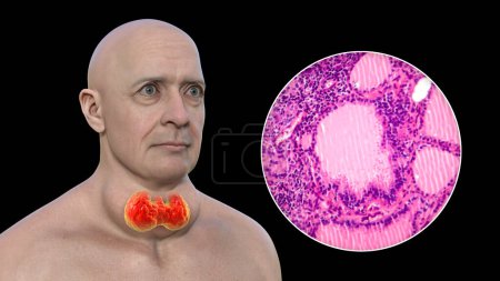 Photo for A 3D illustration of a man with enlarged thyroid gland and exophthalmos, alongside with a micrograph image of thyroid tissue affected by toxic goiter. - Royalty Free Image