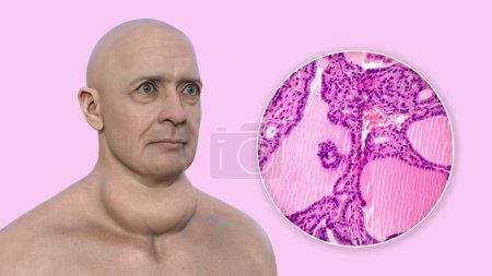Photo for A 3D illustration of a man with enlarged thyroid gland and exophthalmos, alongside with a micrograph image of thyroid tissue affected by toxic goiter. - Royalty Free Image