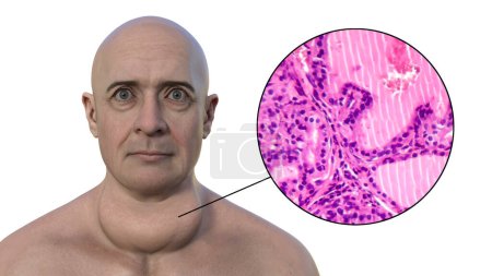 Foto de Una ilustración 3D de un hombre con agrandamiento de la glándula tiroides y exoftalmos, junto con una imagen micrográfica del tejido tiroideo afectado por el bocio tóxico. - Imagen libre de derechos