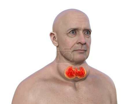 Téléchargez les photos : Un homme avec une glande thyroïde élargie et l'exophtalmie, illustration photoréaliste 3D. - en image libre de droit