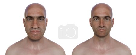 Photo for Acromegaly in a man, and the same healthy man. 3D illustration showing an increase in the size of the hands and face due to overproduction of somatotrophin caused by a tumour of the pituitary gland. - Royalty Free Image