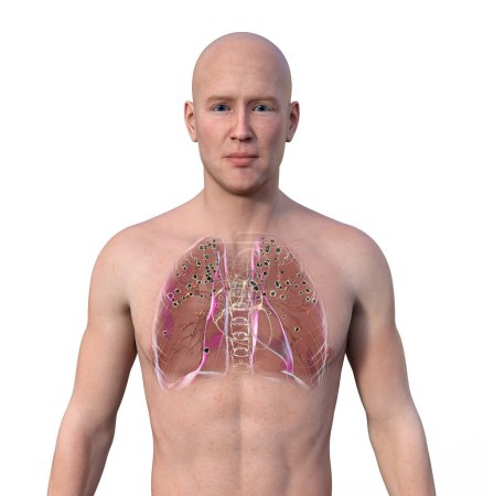 Téléchargez les photos : Un homme avec des nodules de silicose dans les poumons, illustration 3D soulignant l'impact de l'exposition à la silice. - en image libre de droit