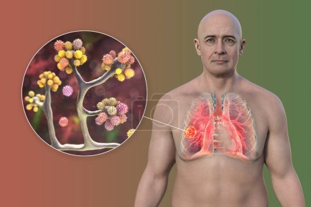 Téléchargez les photos : Un homme présentant une lésion de la mucormycose pulmonaire et une vue rapprochée des champignons Cunninghamella bertholletiae, l'un des agents étiologiques de la mucormycose pulmonaire, illustration 3D. - en image libre de droit