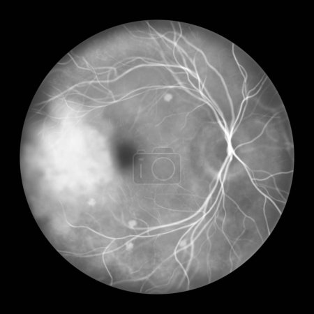 Photo for Retina in blastomycosis (infection caused by fungi Blastomyces dermatitidis) as seen in fluorescein angiography. Illustration shows scattered choroidal infiltrates and a mass lesion with dye leakage. - Royalty Free Image