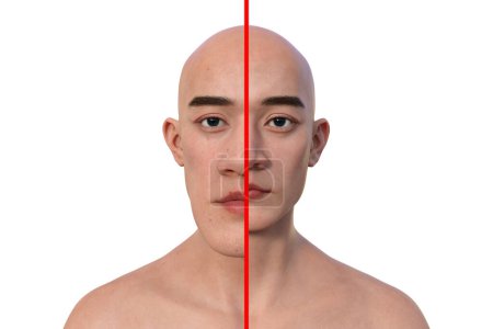 Foto de Acromegalia en un hombre, y el mismo hombre sano. Ilustración 3D que muestra un aumento en el tamaño de las manos y la cara debido a la sobreproducción de somatotropina causada por un tumor de la glándula pituitaria. - Imagen libre de derechos